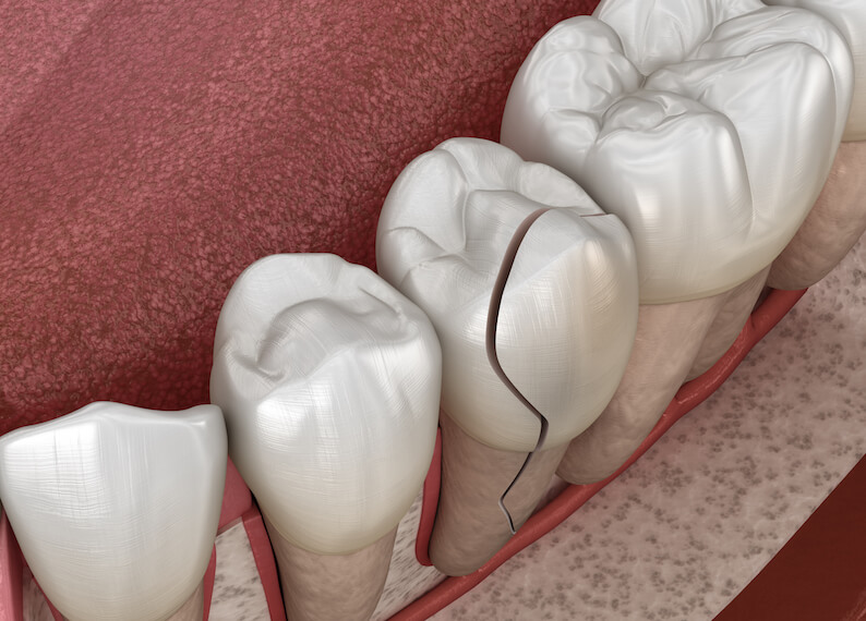 fissure dans les dents causée par la mastication de glace