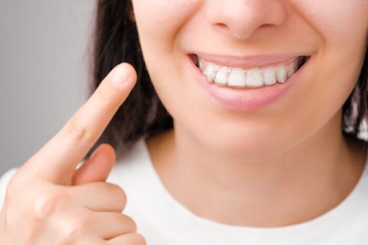 femme-avec-un-sourire-parfait-montre-avec-des-gouttières-transparentes-au-doigt-ses-dents