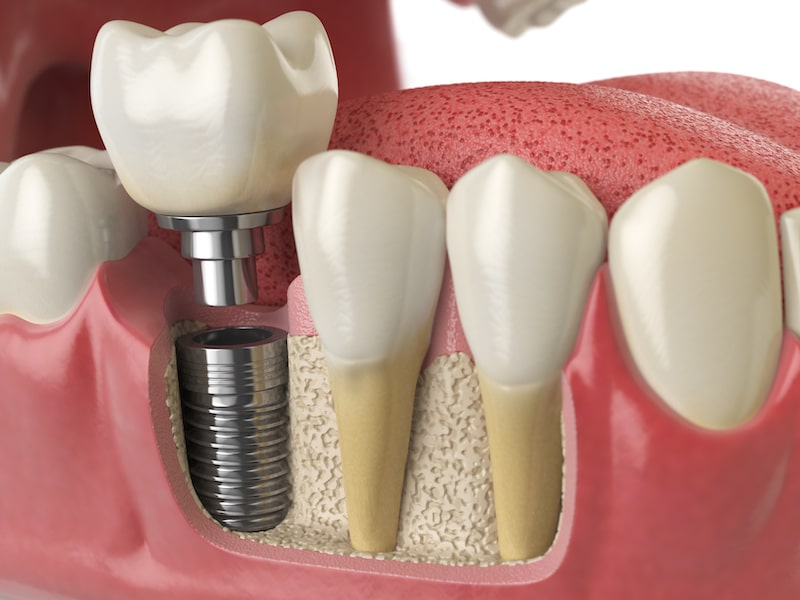 Rendu d'illustration d'ordinateur d'un implant dentaire.