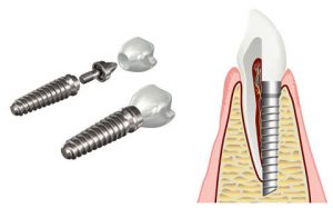 Implant dentaire dans l'os de la mâchoire