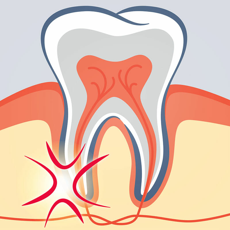 Illustration d'une dent avec un problème de racine