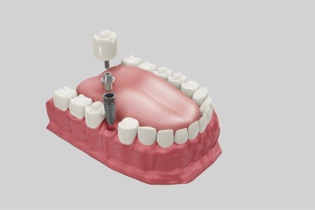 implants dentaires - Positive Dental