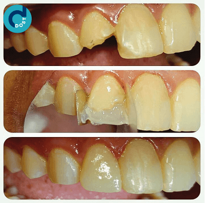 Collage direct des dents avant et après le traitement