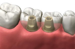 implant dentaire double