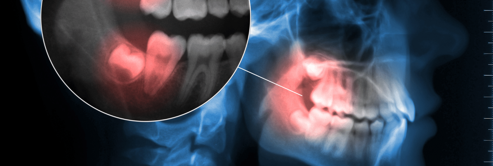 Extraction de Dents de Sagesse à Dubaï, Clinique Dentaire Versailles