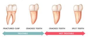 types de dents cassées